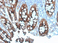 IHC staining of FFPE human colon carcinoma tissue with CEA antibody. HIER: boil tissue sections in pH 9 10mM Tris with 1mM EDTA for 20 min and allow to cool before testing.