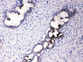 IHC testing of FFPE human breast cancer tissue with ATF6 antibody at 1ug/ml. Required HIER: steam section in pH6 citrate buffer for 20 min and allow to cool prior to testing.