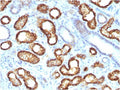 IHC staining of FFPE human renal cell carcinoma with recombinant AMACR antibody. HIER: boil tissue sections in pH 9 10mM Tris with 1mM EDTA for 20 min and allow to cool before testing.