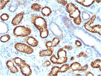 IHC staining of FFPE human renal cell carcinoma with recombinant AMACR antibody. HIER: boil tissue sections in pH 9 10mM Tris with 1mM EDTA for 20 min and allow to cool before testing.