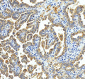 Immunohistochemical staining of xCT/SLC7A11 using anti-SLC7A11 antibody. xCT/SLC7A11 was detected in a paraffin-embedded section of human ovraian cancer tissue. Heat mediated antigen retrieval was performed in EDTA buffer (pH 8.0, epitope retrieval solution). The tissue section was blocked with 10% goat serum. The tissue section was then incubated with 2 ug/ml rabbit anti-SLC7A11 antibody overnight at 4oC. Peroxidase Conjugated Goat Anti-rabbit IgG was used as secondary antibody and incubated for 30 minutes
