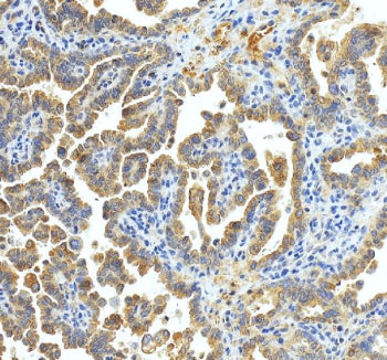 Immunohistochemical staining of xCT/SLC7A11 using anti-SLC7A11 antibody. xCT/SLC7A11 was detected in a paraffin-embedded section of human ovraian cancer tissue. Heat mediated antigen retrieval was performed in EDTA buffer (pH 8.0, epitope retrieval solution). The tissue section was blocked with 10% goat serum. The tissue section was then incubated with 2 ug/ml rabbit anti-SLC7A11 antibody overnight at 4oC. Peroxidase Conjugated Goat Anti-rabbit IgG was used as secondary antibody and incubated for 30 minutes