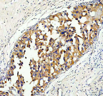 Immunohistochemical staining of Serine racemase using anti-Serine racemase antibody. Serine racemase was detected in a paraffin-embedded section of human breast cancer tissue. Heat mediated antigen retrieval was performed in EDTA buffer (pH 8.0, epitope retrieval solution). The tissue section was blocked with 10% goat serum. The tissue section was then incubated with 2 ug/ml rabbit anti-Serine racemase antibody overnight at 4oC.