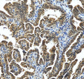 Immunohistochemical staining of STRBP using anti-STRBP antibody. STRBP was detected in a paraffin-embedded section of human ovarian cancer tissue. Heat mediated antigen retrieval was performed in EDTA buffer (pH 8.0, epitope retrieval solution). The tissue section was blocked with 10% goat serum. The tissue section was then incubated with 2 ug/ml rabbit anti-STRBP antibody overnight at 4oC. Peroxidase Conjugated Goat Anti-rabbit IgG was used as secondary antibody and incubated for 30 min at 37oC.