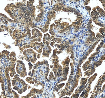 Immunohistochemical staining of STRBP using anti-STRBP antibody. STRBP was detected in a paraffin-embedded section of human ovarian cancer tissue. Heat mediated antigen retrieval was performed in EDTA buffer (pH 8.0, epitope retrieval solution). The tissue section was blocked with 10% goat serum. The tissue section was then incubated with 2 ug/ml rabbit anti-STRBP antibody overnight at 4oC. Peroxidase Conjugated Goat Anti-rabbit IgG was used as secondary antibody and incubated for 30 min at 37oC.