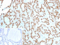 IHC staining of FFPE human thyroid tissue with Cyclin D1 antibody (clone CCND1/12039). Inset: PBS used in place of primary Ab (secondary Ab negative control). HIER: boil tissue sections in pH 9 10mM Tris with 1mM EDTA for 20 min and allow to cool before testing.