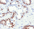 IHC staining of FFPE human breast cancer with Estrogen Receptor alpha antibody (clone NR3Ga-4R). Required HIER: boil tissue sections in pH 9 10mM Tris with 1mM EDTA for 10-20 min followed by cooling at RT for 20 min.