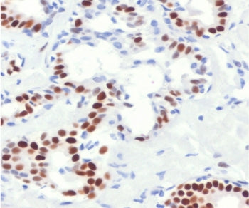 IHC staining of FFPE human breast cancer with Estrogen Receptor alpha antibody (clone NR3Ga-4R). Required HIER: boil tissue sections in pH 9 10mM Tris with 1mM EDTA for 10-20 min followed by cooling at RT for 20 min.