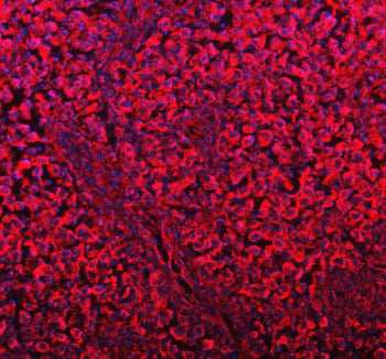 Immunofluorescent staining of FFPE human testis cancer tissue with DYNLT1 antibody (red) and DAPI nuclear stain (blue). HIER: steam section in pH8 EDTA buffer for 20 min.