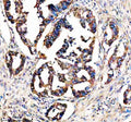 Immunohistochemical staining of STX4 using anti-STX4 antibody. STX4 was detected in a paraffin-embedded section of human colon cancer tissue. Heat mediated antigen retrieval was performed in EDTA buffer (pH 8.0, epitope retrieval solution). The tissue section was blocked with 10% goat serum. The tissue section was then incubated with 2 ug/ml rabbit anti-STX4 antibody overnight at 4oC. Peroxidase Conjugated Goat Anti-rabbit IgG was used as secondary antibody and incubated for 30 min at 37oC.