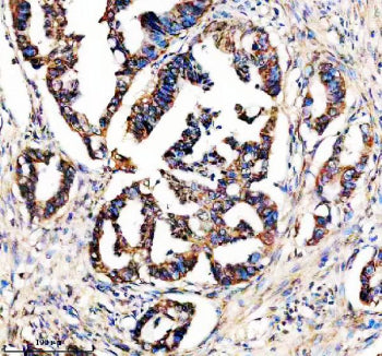 Immunohistochemical staining of STX4 using anti-STX4 antibody. STX4 was detected in a paraffin-embedded section of human colon cancer tissue. Heat mediated antigen retrieval was performed in EDTA buffer (pH 8.0, epitope retrieval solution). The tissue section was blocked with 10% goat serum. The tissue section was then incubated with 2 ug/ml rabbit anti-STX4 antibody overnight at 4oC. Peroxidase Conjugated Goat Anti-rabbit IgG was used as secondary antibody and incubated for 30 min at 37oC.