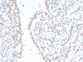 IHC staining of FFPE human renal oncocytoma with recombinant SF-1 antibody (clone NR5A1/4368R). HIER: boil tissue sections in pH 9 10mM Tris with 1mM EDTA for 20 min and allow to cool before testing.