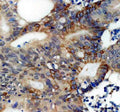 IHC staining of FFPE human colon cancer tissue with Perilipin 3 antibody, HRP-secondary and DAB substrate. HIER: boil tissue sections in pH8 EDTA for 20 min and allow to cool before testing.