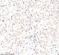 Immunohistochemical staining of Lamin B2 using anti-Lamin B2 antibody. Lamin B2 was detected in a paraffin-embedded section of human colon cancer tissue. Heat mediated antigen retrieval was performed in EDTA buffer (pH 8.0, epitope retrieval solution). The tissue section was blocked with 10% goat serum. The tissue section was then incubated with 2 ug/ml rabbit anti-Lamin B2 antibody overnight at 4oC. Peroxidase Conjugated Goat Anti-rabbit IgG was used as secondary antibody and incubated for 30 min at 37oC.