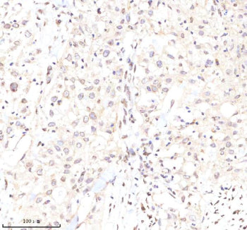 Immunohistochemical staining of Lamin B2 using anti-Lamin B2 antibody. Lamin B2 was detected in a paraffin-embedded section of human colon cancer tissue. Heat mediated antigen retrieval was performed in EDTA buffer (pH 8.0, epitope retrieval solution). The tissue section was blocked with 10% goat serum. The tissue section was then incubated with 2 ug/ml rabbit anti-Lamin B2 antibody overnight at 4oC. Peroxidase Conjugated Goat Anti-rabbit IgG was used as secondary antibody and incubated for 30 min at 37oC.