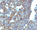 IHC: Formalin-fixed, paraffin-embedded human ovarian carcinoma stained with CD99 antibody (clone MIC2/877).
