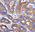 Immunohistochemical staining of Cathepsin F/CTSF using anti-CTSF antibody. Cathepsin F/CTSF was detected in a paraffin-embedded section of human stomach cancer tissue. Heat mediated antigen retrieval was performed in EDTA buffer (pH 8.0, epitope retrieval solution). The tissue section was blocked with 10% goat serum. The tissue section was then incubated with 2 ug/ml rabbit anti-CTSF antibody overnight at 4oC.