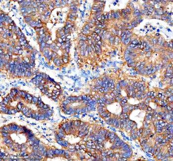 Immunohistochemical staining of Cathepsin F/CTSF using anti-CTSF antibody. Cathepsin F/CTSF was detected in a paraffin-embedded section of human stomach cancer tissue. Heat mediated antigen retrieval was performed in EDTA buffer (pH 8.0, epitope retrieval solution). The tissue section was blocked with 10% goat serum. The tissue section was then incubated with 2 ug/ml rabbit anti-CTSF antibody overnight at 4oC.