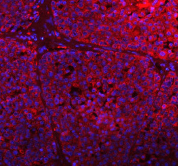 Immunofluorescent staining of GCLC using anti-GCLC antibody (red). GCLC was detected in a paraffin-embedded section of human liver cancer tissue. Heat mediated antigen retrieval was performed in EDTA buffer (pH 8.0, epitope retrieval solution). The tissue section was blocked with 10% goat serum. The tissue section was then incubated with 5 ug/ml rabbit anti-GCLC antibody overnight at 4oC. DyLight 594 Conjugated Goat Anti-Rabbit IgG was used as secondary antibody at 1:500 dilution and incubated for 30 minute