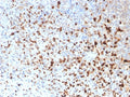 IHC staining of FFPE human cervix with HSV1 antibody (clone 10A3). Required HIER: boil tissue sections in pH 9 10mM Tris with 1mM EDTA for 10-20 min followed by cooling at RT for 20 min.