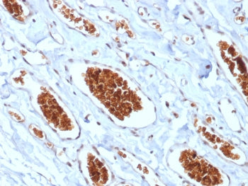 IHC testing of FFPE human angiosarcoma with recombinant GYPA antibody (clone rGYPA/280). Required HIER: boil tissue sections in 10mM citrate buffer, pH 6, for 10-20 min.