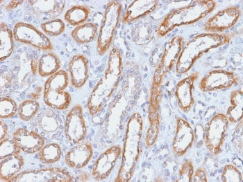 IHC testing of FFPE human renal cell carcinoma with Integrin beta 3 antibody (clone ITGB3/2166R). Required HIER: boil tissue sections in 10mM Tris with 1mM EDTA, pH9, for 10-20 min followed by cooling at RT for 20 min.