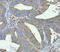 IHC staining of FFPE moderately differentiated adenocarcinoma of human rectum tissue with ACSL4 antibody. HIER: boil tissue sections in pH8 EDTA for 20 min and allow to cool before testing.