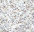 IHC staining of FFPE human breast cancer tissue with NEDD9 antibody. HIER: boil tissue sections in pH8 EDTA for 20 min and allow to cool before testing.