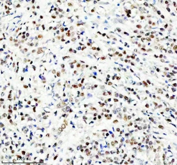 IHC staining of FFPE human breast cancer tissue with NEDD9 antibody. HIER: boil tissue sections in pH8 EDTA for 20 min and allow to cool before testing.