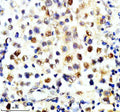 Immunohistochemical staining of SLX4 using anti-SLX4 antibody. SLX4 was detected in a paraffin-embedded section of human testis cancer tissue. Heat mediated antigen retrieval was performed in EDTA buffer (pH 8.0, epitope retrieval solution). The tissue section was blocked with 10% goat serum. The tissue section was then incubated with 2 ug/ml rabbit anti-SLX4 antibody overnight at 4oC. Peroxidase Conjugated Goat Anti-rabbit IgG was used as secondary antibody and incubated for 30 min at 37oC.
