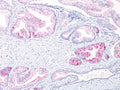 Formalin-fixed, paraffin-embedded human prostate carcinoma stained with p504S antibody (13H4)