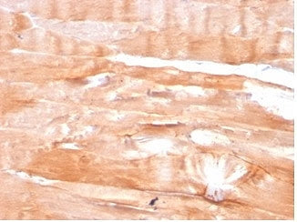 IHC staining of FFPE human skeletal muscle tissue with DMD antibody (clone DMD/3676). HIER: boil tissue sections in pH 9 10mM Tris with 1mM EDTA for 20 min and allow to cool before testing.