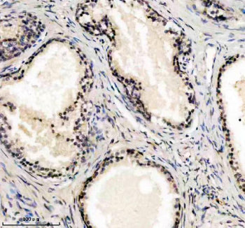 Immunohistochemical staining of UBE2F using anti-UBE2F antibody. UBE2F was detected in a paraffin-embedded section of human prostate cancer tissue. Heat mediated antigen retrieval was performed in EDTA buffer (pH 8.0, epitope retrieval solution). The tissue section was blocked with 10% goat serum. The tissue section was then incubated with 2 ug/ml rabbit anti-UBE2F antibody overnight at 4oC. Peroxidase Conjugated Goat Anti-rabbit IgG was used as secondary antibody and incubated for 30 min at 37oC.