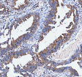 IHC staining of FFPE human rectum adenocarcinoma tissue with IARS2 antibody. HIER: boil tissue sections in pH8 EDTA for 20 min and allow to cool before testing.