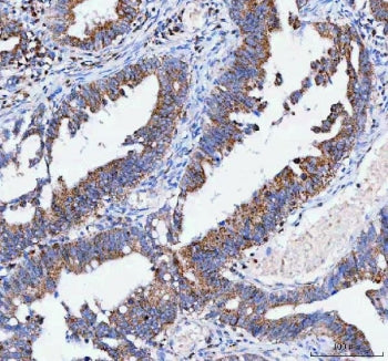IHC staining of FFPE human rectum adenocarcinoma tissue with IARS2 antibody. HIER: boil tissue sections in pH8 EDTA for 20 min and allow to cool before testing.