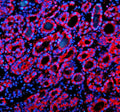 Immunofluorescent staining of SIL1 using anti-SIL1 antibody (red). SIL1 was detected in a paraffin-embedded section of human thyroid cancer tissue. Heat mediated antigen retrieval was performed in EDTA buffer (pH 8.0, epitope retrieval solution). The tissue section was blocked with 10% goat serum. The tissue section was then incubated with 5 ug/ml rabbit anti-SIL1 antibody overnight at 4oC. Cy3 Conjugated Goat Anti-Rabbit IgG was used as secondary antibody at 1:500 dilution and incubated for 30 min at 37oC.