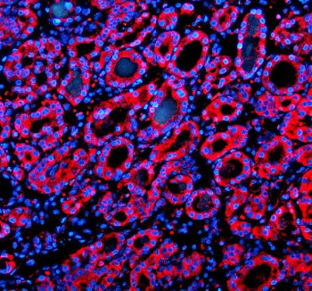 Immunofluorescent staining of SIL1 using anti-SIL1 antibody (red). SIL1 was detected in a paraffin-embedded section of human thyroid cancer tissue. Heat mediated antigen retrieval was performed in EDTA buffer (pH 8.0, epitope retrieval solution). The tissue section was blocked with 10% goat serum. The tissue section was then incubated with 5 ug/ml rabbit anti-SIL1 antibody overnight at 4oC. Cy3 Conjugated Goat Anti-Rabbit IgG was used as secondary antibody at 1:500 dilution and incubated for 30 min at 37oC.