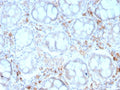 IHC staining of FFPE human colon carcinoma with recombinant CD209 antibody (clone rC209/1781). HIER: boil tissue sections in pH 9 10mM Tris with 1mM EDTA for 10-20 min and allow to cool before testing.