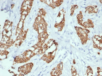 IHC staining of FFPE human breast cancer with TrkC antibody (clone NTRK3/7140). HIER: boil tissue sections in pH 9 10mM Tris with 1mM EDTA for 20 min and allow to cool before testing.