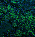 Immunofluorescent staining of FFPE human lung cancer with CD74 antibody (green) and DAPI nuclear stain (blue). HIER: steam section in pH8 EDTA for 20 min.
