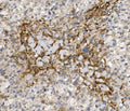 IHC staining of FFPE human liver cancer with CCR2 antibody. HIER: boil tissue sections in pH8 EDTA for 20 min and allow to cool before testing.