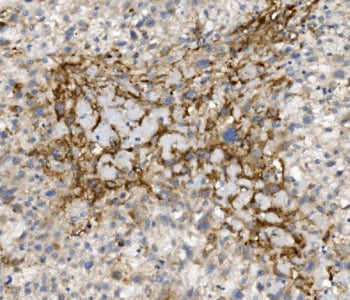 IHC staining of FFPE human liver cancer with CCR2 antibody. HIER: boil tissue sections in pH8 EDTA for 20 min and allow to cool before testing.