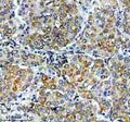 IHC staining of FFPE human liver cancer tissue with VASP antibody, HRP-secondary and DAB substrate. HIER: boil tissue sections in pH8 EDTA for 20 min and allow to cool before testing.