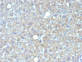 IHC staining of FFPE human hepatocellular carcinoma tissue with Glypican-3 antibody (clone GPC3/7419). HIER: boil tissue sections in pH 9 10mM Tris with 1mM EDTA for 20 min and allow to cool before testing.