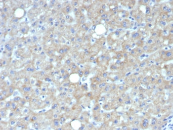 IHC staining of FFPE human hepatocellular carcinoma tissue with Glypican-3 antibody (clone GPC3/7419). HIER: boil tissue sections in pH 9 10mM Tris with 1mM EDTA for 20 min and allow to cool before testing.