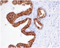 IHC staining of FFPE human prostate carcinoma tissue with recombinant EpCAM antibody (clone rEGP40/826). HIER: boil tissue sections in pH 9 10mM Tris with 1mM EDTA for 20 min and allow to cool before testing.