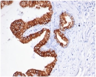 IHC staining of FFPE human prostate carcinoma tissue with recombinant EpCAM antibody (clone rEGP40/826). HIER: boil tissue sections in pH 9 10mM Tris with 1mM EDTA for 20 min and allow to cool before testing.