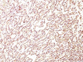 IHC: Formalin-fixed, paraffin-embedded human angiosarcoma stained with PODXL antibody (4F10).