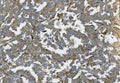 IHC staining of FFPE human ovarian cancer with K-Cadherin antibody. HIER: boil tissue sections in pH8 EDTA for 20 min and allow to cool before testing.