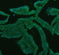 Immunofluorescent staining of GATM using anti-GATM antibody (green). GATM was detected in a paraffin-embedded section of human breast cancer tissue. Heat mediated antigen retrieval was performed in EDTA buffer (pH 8.0, epitope retrieval solution). The tissue section was blocked with 10% goat serum. The tissue section was then incubated with 5 ug/ml rabbit anti-GATM antibody overnight at 4oC.